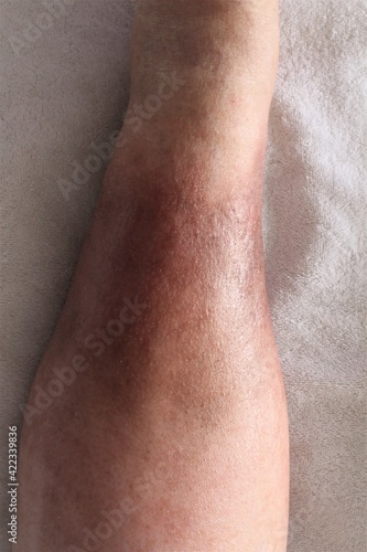 Top view of a woman s leg is shown  suffering from Chronic Venous Insufficiency with mild cellulitis in her legs. In bed as she rest to relieve heaviness  swelling  pain and redness in the leg. 