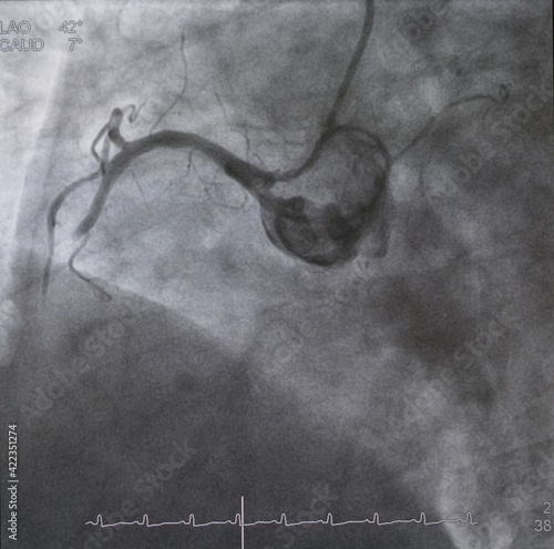 Принти на полотні Coronary angiogram (CAG) was performed total occlusion at right coronary artery (RCA)