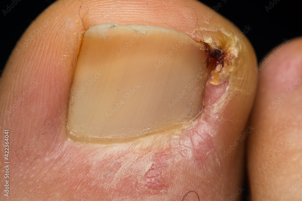 close-up photo of a toenail infection in human close-up photo of a toenail infection in human