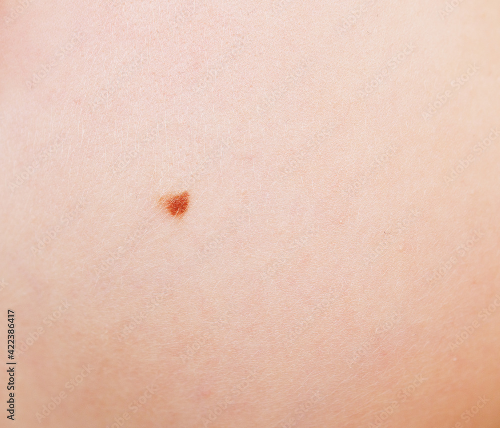 Fototapeta premium Mole on skin