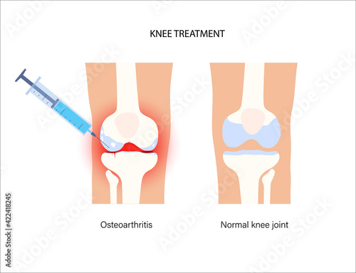 Knee Injection concept