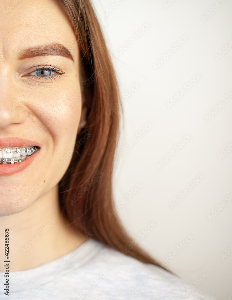 The smile of a young girl with braces on her white teeth. Teeth straightening. The smile of a young girl with braces on her white teeth. Teeth straightening.