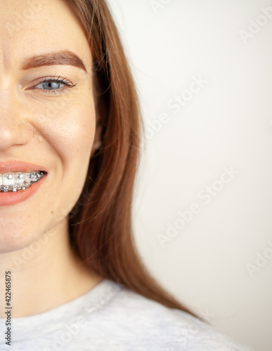 The smile of a young girl with braces on her white teeth. Teeth straightening.