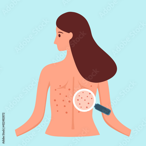 Woman with back acne in flat design. Skin problem and acne treatment.