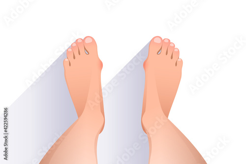 Top view of bare feet with hallux valgus