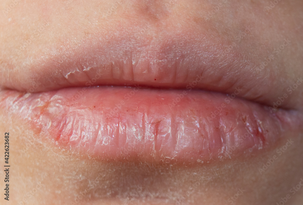 chapped and dehydrated dry lips. chapped lips in winter.Close-up pale female lips cracked chapped and dehydrated dry lips. chapped lips in winter.Close-up pale female lips cracked