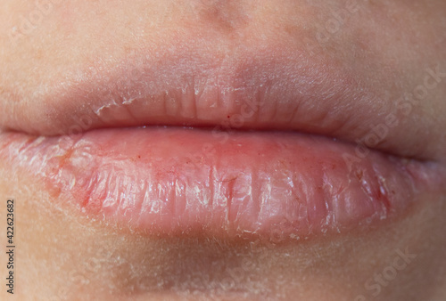 chapped and dehydrated dry lips. chapped lips in winter.Close-up pale female lips cracked photo
