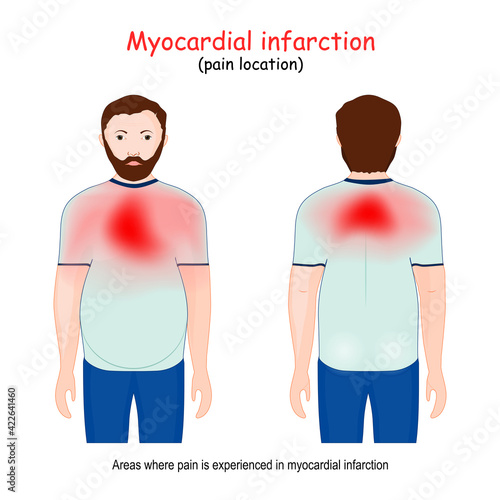Myocardial Infarction areas. Heart attack. pain location