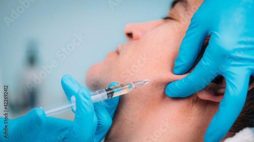 Dermal Filler for Men  Jawline Injection