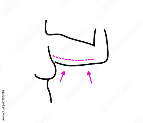 Aesthetics in arms.Body contour dotted line vector illustration. Plastic surgery. Getting rid of excess fat.
