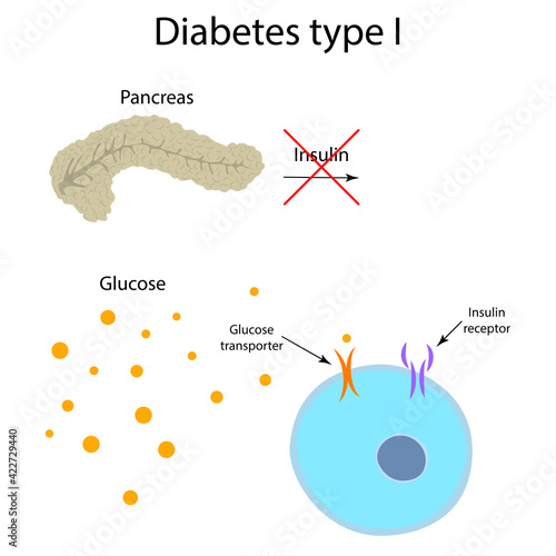 Diabetes type 1. Pancreas, insulin receptor, glucose transporter, cell.