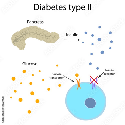Diabetes type 2. Pancreas, insulin receptor, glucose transporter, cell.