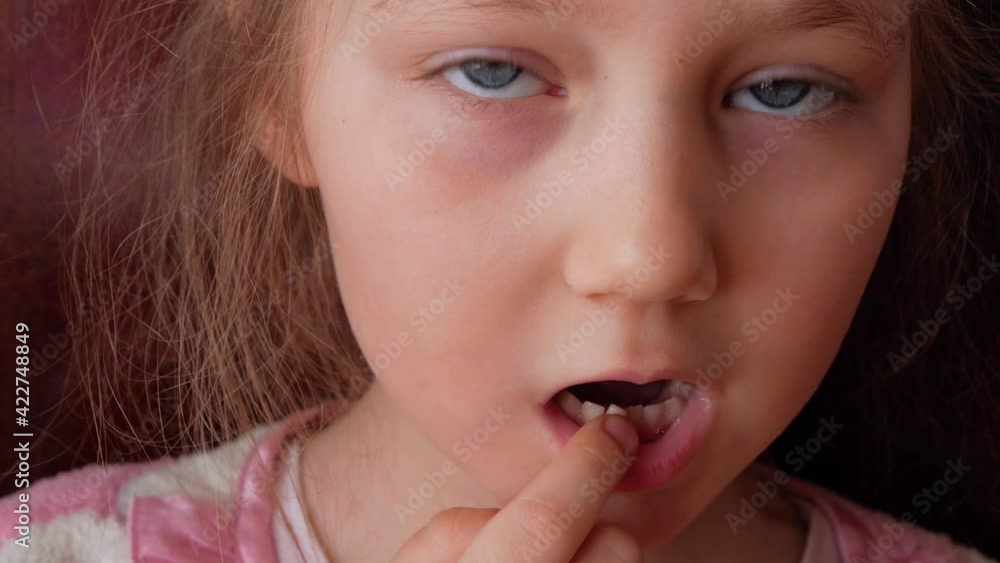 Cute preschooler child wobbling her lower milk tooth and smiling. Deciduous tooth replacement by permanent 4k footage dark background. Scared little girl 6-7 years old has lost incisor. Cute preschooler child wobbling her lower milk tooth and smiling. Deciduous tooth replacement by permanent 4k footage dark background. Scared little girl 6-7 years old has lost incisor.
