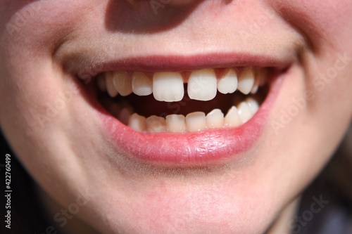 sorriso denti bambino dentista carie denti bianchi 