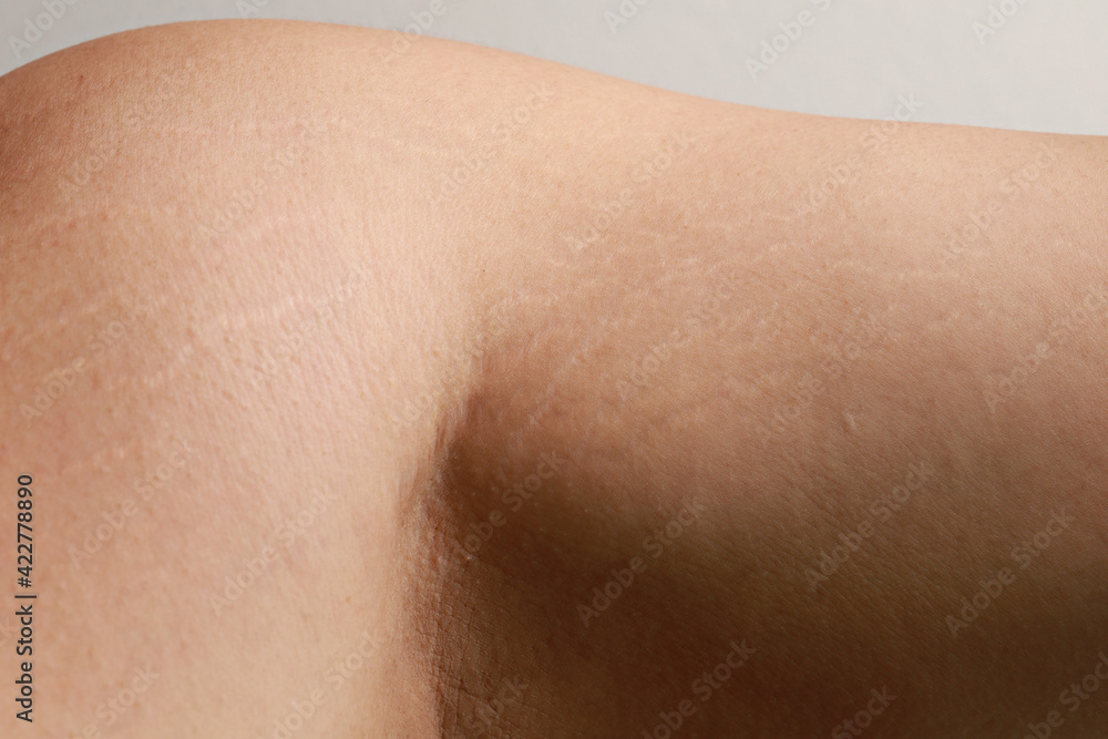 Body striae, stretch marks on an Asian adult arm. Body striae, stretch marks on an Asian adult arm.