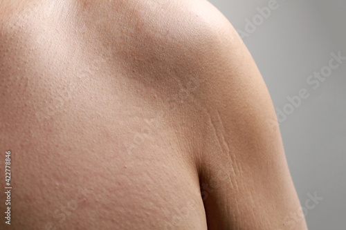 Body striae, stretch marks on an Asian adult arm. photo