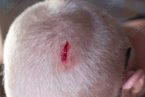 Injury to the scalp. Blood escapes from a chopped head wound due to falling metal reinforcement. Failure to comply with safety techniques