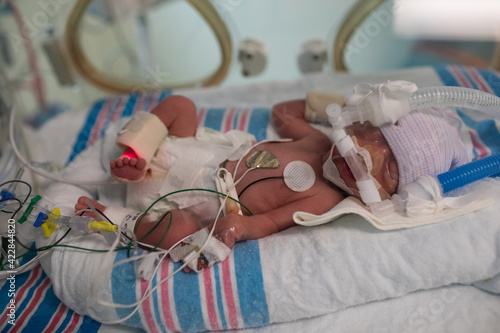 Premature newborn 7-day-old baby sleeping in incubator in intensive care with health monitor lines connected