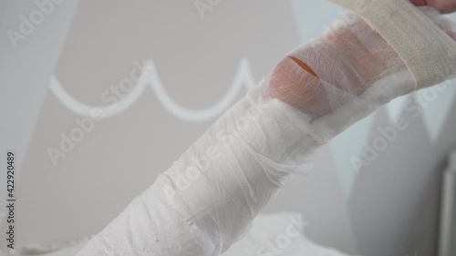 Close-up of plaster langette dressing after surgery to stitch the Achilles tendon. photo