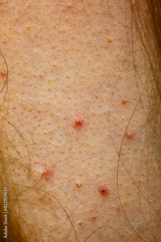 Closeup skin with acne moles and red spots.