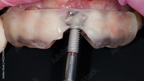 the dental implant is inserted through the template during the operation