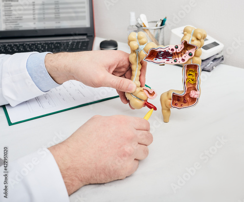 Doctor pointing pen to inflamed appendicitis using a intestines anatomical model. Consultation gastroenterologist for a patient with stomach pain photo