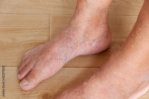 Focus of leg that is varicose veins and wrinkled skin of the elderly asian woman, Various illnesses of the elderly and good health concept. © damrong