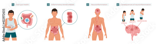 Poor gut health leads to chronic inflammation, which in turn leads to neuroinflammation, which can cause stress, anxiety, and depression. Vector illustration