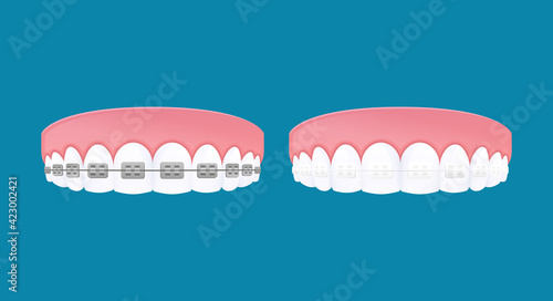 Types of braces system. Metal and Clear brackets teeth. Vector cartoon style.