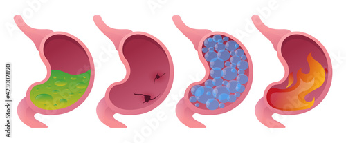 Stomach upset, gastritis, bloating, ulcers, acidity, overeating. Vector cartoon style.