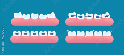 Alignment of teeth and bite correction with the help of braces system. Vector cartoon style.