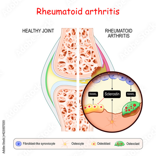 Rheumatoid arthritis