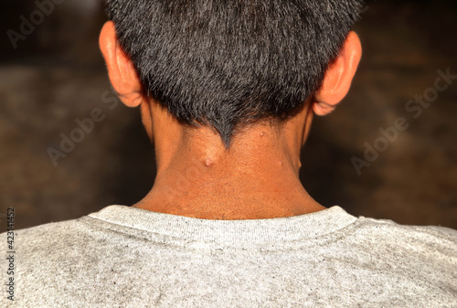 Neurofibromatosis in the nape of the neck photo