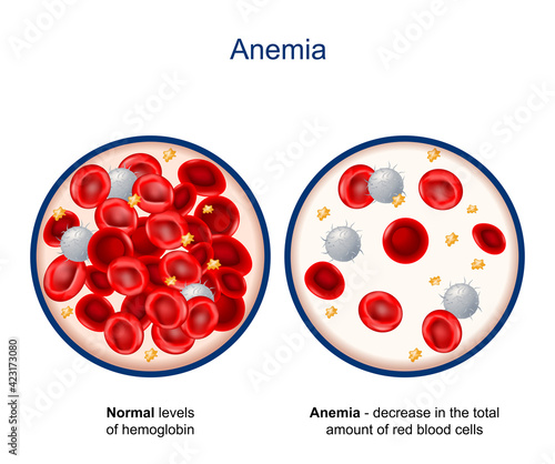 Anemia. Close-up of blood vessel with erythrocyte, platelets and white blood cells (lymphocytes)