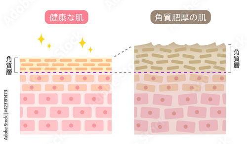 角質肥厚　健康な肌　断面図　