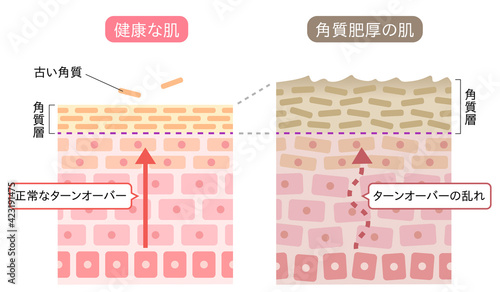 角質肥厚　健康な肌　断面図　
