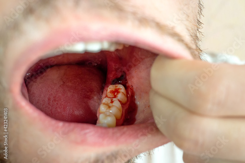 Close-up of a tooth gap in a male mouth for a dental implant with fresh open wound and blood, Germany