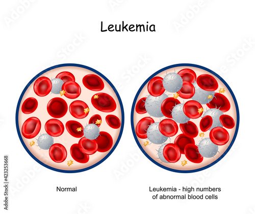Leukemia. Blood of healthy person and  blood cancer.