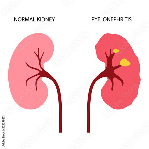 Kidney disease concept