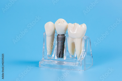 Dental crowns, imitation of a dental prosthesis of a dental bridge with implant