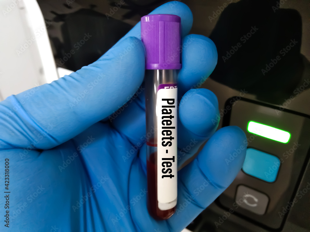 The blood in EDTA tube for test complete Blood Count (cbc) testing