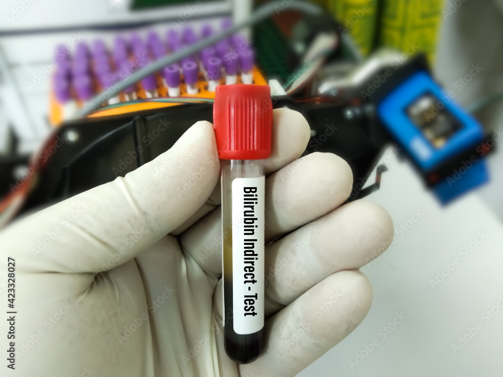 Scientist hold blood samples for Bilirubin test (total bilirubin