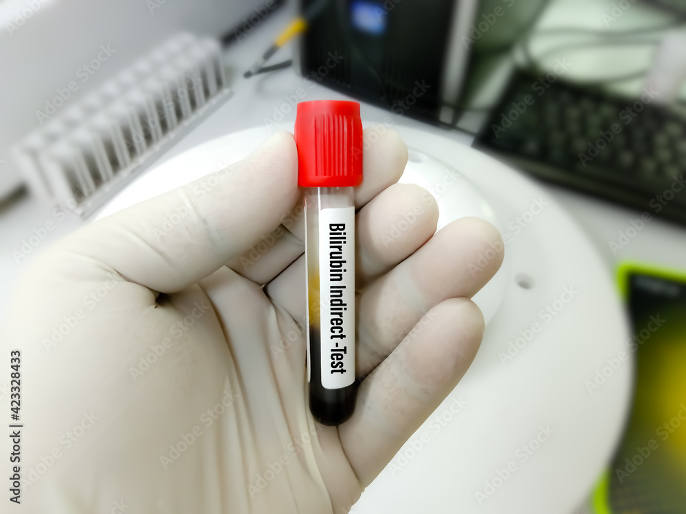 Scientist hold blood samples for Bilirubin test (total bilirubin