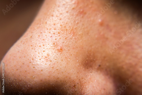 Closed-up of pimple blackheads on the nose of an european teenager  Enlarged pores on the face