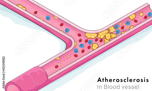 Blocking RBC and Immune cells by atherosclerotic plaques.