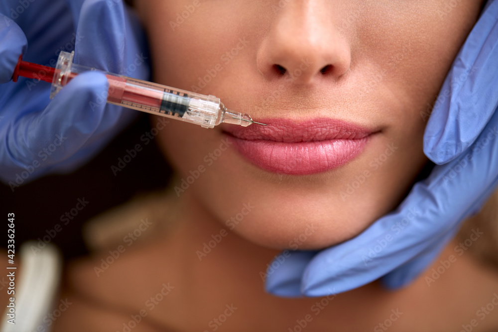 woman receiving a injection in her lips correcting simetry. Plastic surgery. woman receiving a injection in her lips correcting simetry. Plastic surgery.