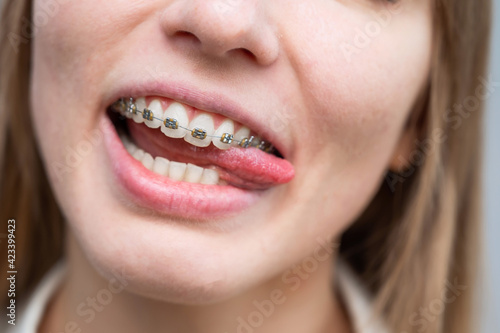 Close-up of a young woman s smile with metal braces on her teeth. Correction of bite
