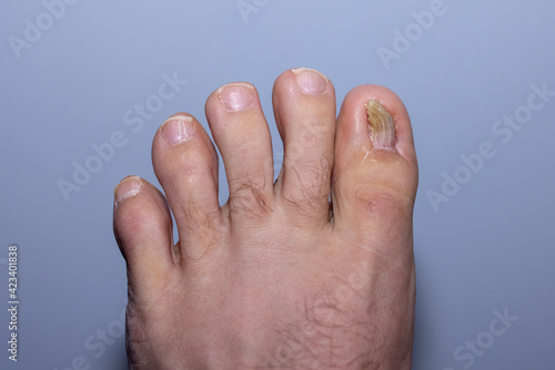 Aftermath of surgey to repair an ingrown toenail photo