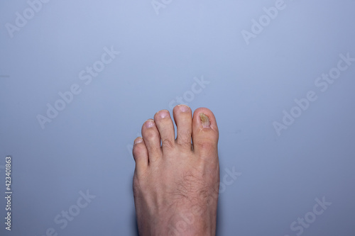 Aftermath of surgey to repair an ingrown toenail