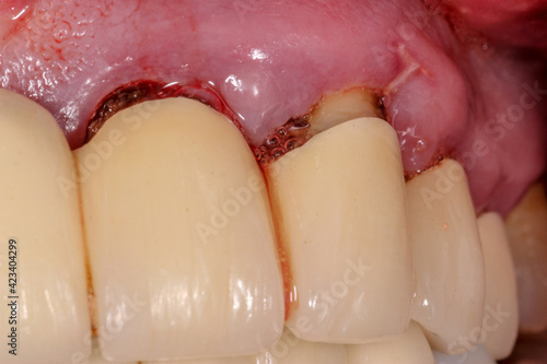 Obraz na plátně A very bad case of periodontitis